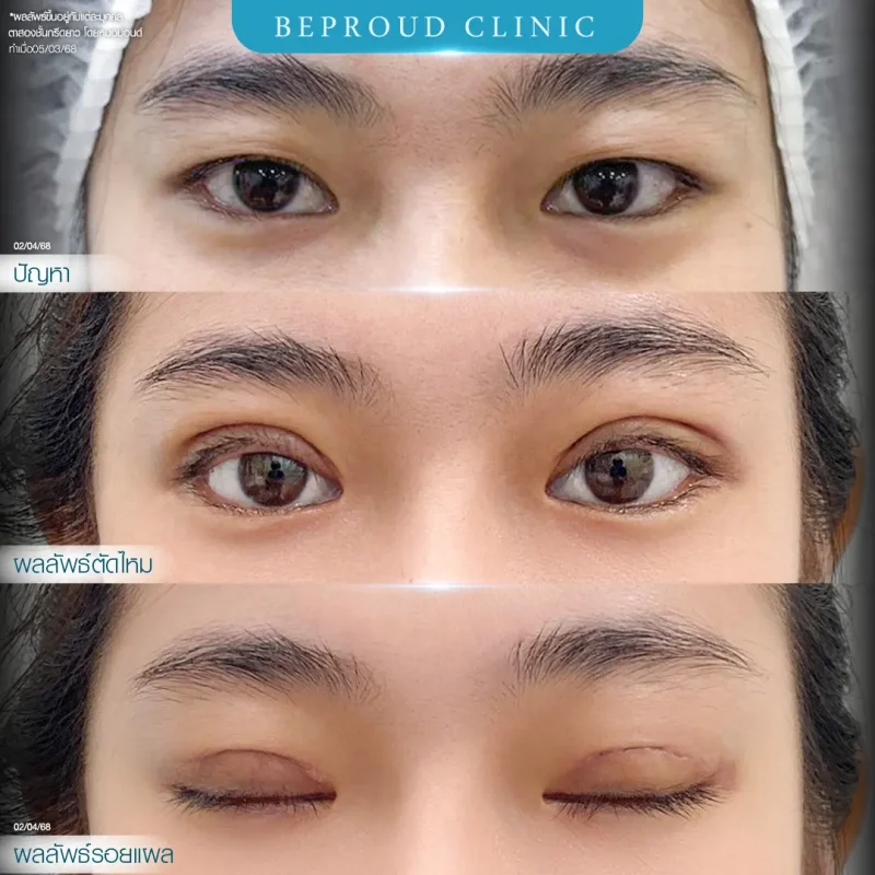 ภาพรีวิวเปรียบเทียบผลลัพธ์ ก่อนทำ-หลังทำศัลยกรรมตาสองชั้น ของเคสตัวอย่าง เทคนิคกรีดตายาว โดยหมอปอนด์ บีพราวด์คลินิก