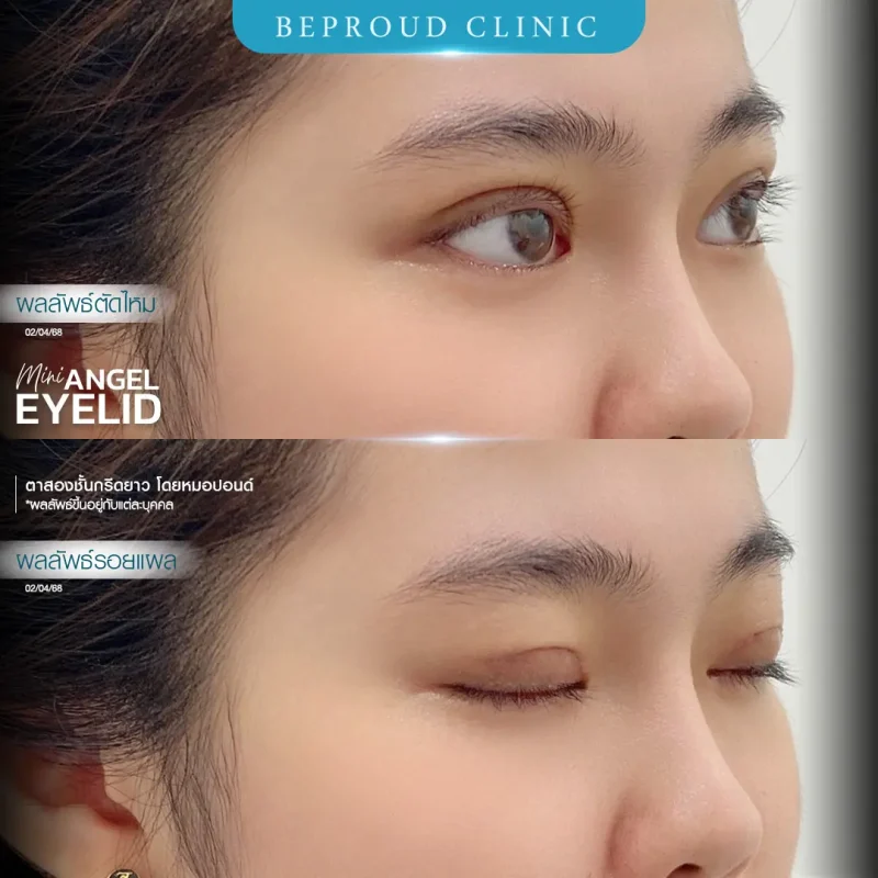 ภาพรีวิวเปรียบเทียบผลลัพธ์ ก่อนทำ-หลังทำศัลยกรรมตาสองชั้น ของเคสตัวอย่าง เทคนิคกรีดตายาว โดยหมอปอนด์ บีพราวด์คลินิก