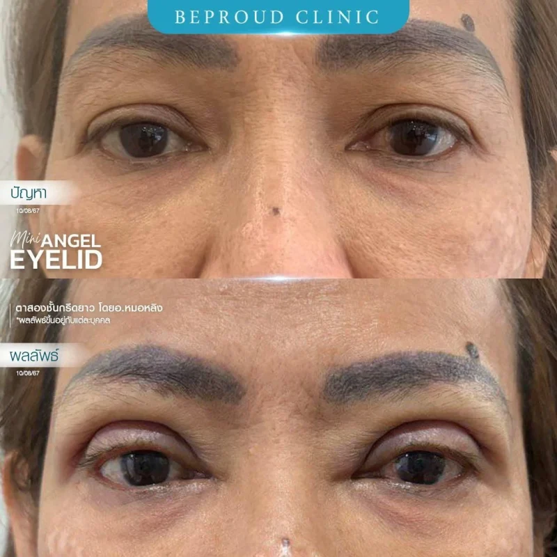 ภาพรีวิวเปรียบเทียบผลลัพธ์ ก่อนทำ-หลังทำศัลยกรรมตาสองชั้น ของเคสตัวอย่าง เทคนิคกรีดตายาว โดยอ.หมอหลิง บีพราวด์คลินิก
