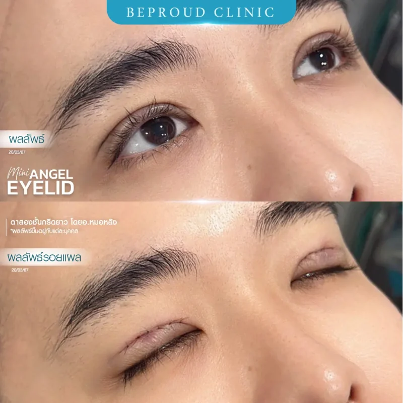 ภาพรีวิวเปรียบเทียบผลลัพธ์ ก่อนทำ-หลังทำศัลยกรรมตาสองชั้นผู้ชาย ของเคสตัวอย่าง เทคนิคกรีดตายาว โดยอ.หมอหลิง บีพราวด์คลินิก
