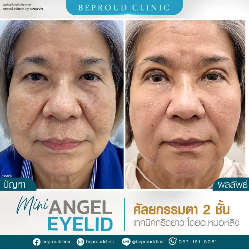 ภาพรีวิวเปรียบเทียบผลลัพธ์ ก่อนทำ-หลังทำศัลยกรรมตาสองชั้น ผู้สูงอายุของเคสตัวอย่าง เทคนิคกรีดตายาว โดยอ.หมอหลิง บีพราวด์คลินิก