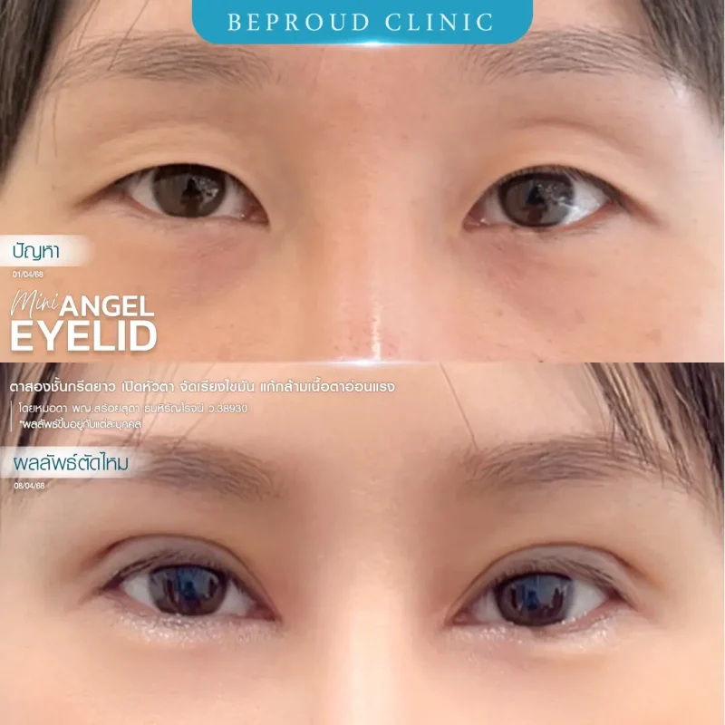 ภาพรีวิวเปรียบเทียบผลลัพธ์ ก่อนทำ-หลังทำศัลยกรรมตาสองชั้น ของเคสตัวอย่าง เทคนิคกรีดตายาว เปิดหัวตา จัดเรียงไขมัน แก้กล้ามเนื้อตาอ่อนแรง โดยหมอดา บีพราวด์คลินิก