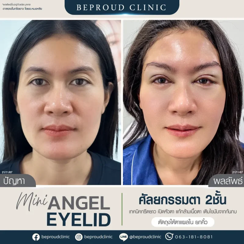 ภาพรีวิวเปรียบเทียบผลลัพธ์ ก่อนทำ-หลังทำศัลยกรรมตาสองชั้น ของเคสตัวอย่าง เทคนิคกรีดตายาว เปิดหัวตา แก้กล้ามเนื้อตา เติมไขมันจากก้นกบ ตัวถุงใต้ตาแผลใน ยกคิ้ว โดยอ.หมอหลิง บีพราวด์คลินิก