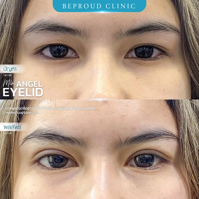 ภาพรีวิวเปรียบเทียบผลลัพธ์ ก่อนทำ-หลังทำศัลยกรรมตาสองชั้น ของเคสตัวอย่าง เทคนิคกรีดตายาว แก้กล้ามเนื้อตาอ่อนแรง โดยอ.หมอหลิง บีพราวด์คลินิก