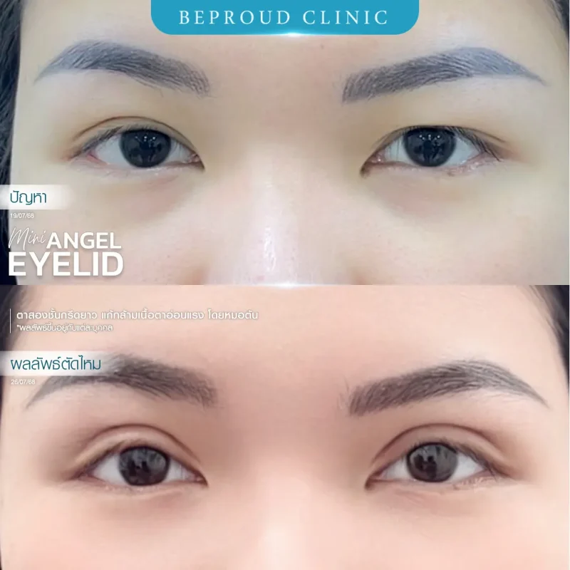 ภาพรีวิวเปรียบเทียบผลลัพธ์ ก่อนทำ-หลังทำศัลยกรรมตาสองชั้น ของเคสตัวอย่าง เทคนิคกรีดตายาว แก้กล้ามเนื้อตาอ่อนแรง โดยหมอต้น บีพราวด์คลินิก