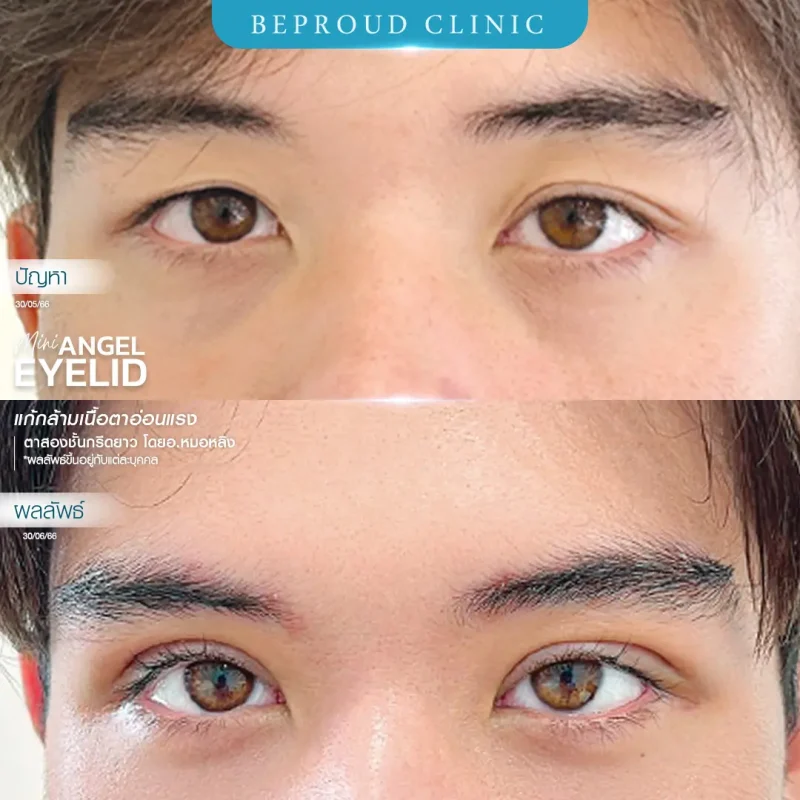 ภาพรีวิวเปรียบเทียบผลลัพธ์ ก่อนทำ-หลังทำศัลยกรรมตาสองชั้นผู้ชาย ของเคสตัวอย่าง เทคนิคกรีดตายาว แก้กล้ามเนื้อตาอ่อนแรง โดยอ.หมอหลิง บีพราวด์คลินิก