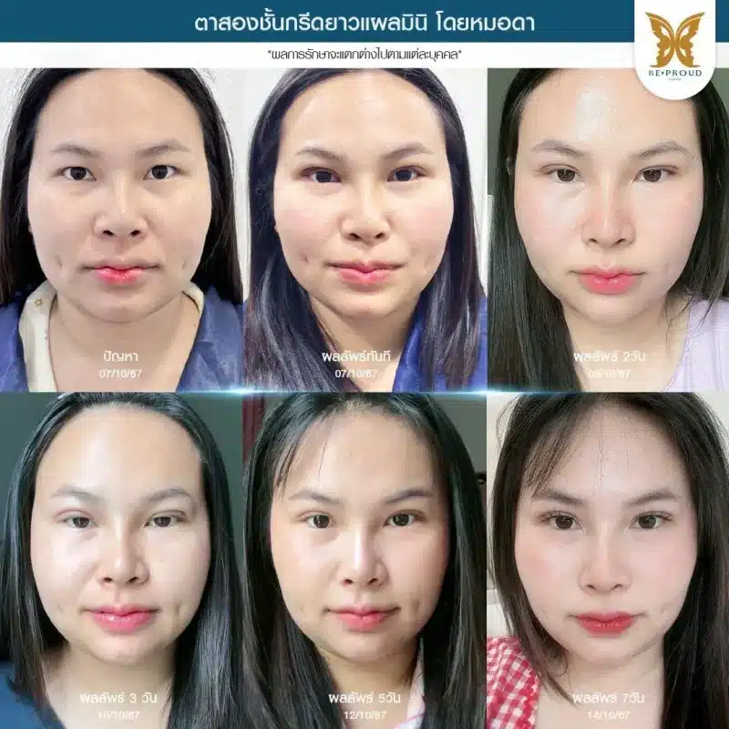 ภาพรีวิวเปรียบเทียบผลลัพธ์ ก่อนทำ-หลังทำศัลยกรรมตาสองชั้น ของเคสตัวอย่าง เทคนิคกรีดตายาวแผลมินิ โดยหมอดา บีพราวด์คลินิก