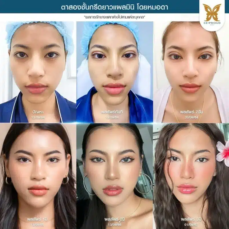 ภาพรีวิวเปรียบเทียบผลลัพธ์ ก่อนทำ-หลังทำศัลยกรรมตาสองชั้น ของเคสตัวอย่าง เทคนิคกรีดตายาวแผลมินิ โดยหมอดา บีพราวด์คลินิก
