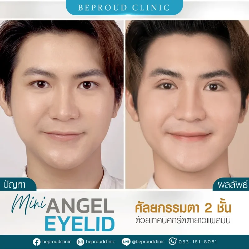 ภาพรีวิวเปรียบเทียบผลลัพธ์ ก่อนทำ-หลังทำศัลยกรรมตาสองชั้นผู้ชาย ของเคสตัวอย่าง เทคนิคกรีดยาวแผลมินิ โดยอ.หมอหลิง บีพราวด์คลินิก