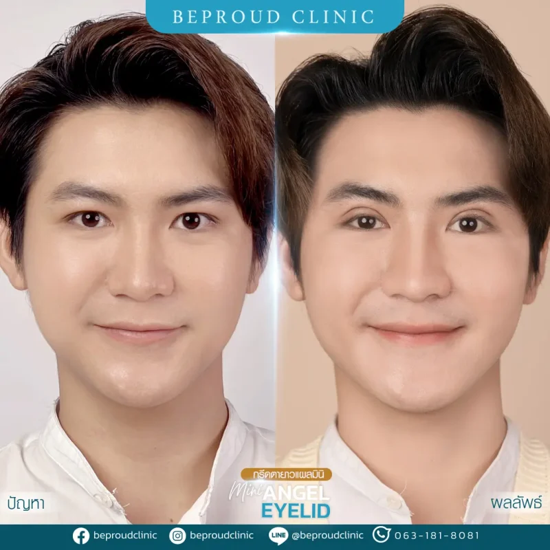 ภาพรีวิวเปรียบเทียบผลลัพธ์ ก่อนทำ-หลังทำศัลยกรรมตาสองชั้นผู้ชาย ของเคสตัวอย่าง เทคนิคกรีดยาวแผลมินิ โดยอ.หมอหลิง บีพราวด์คลินิก