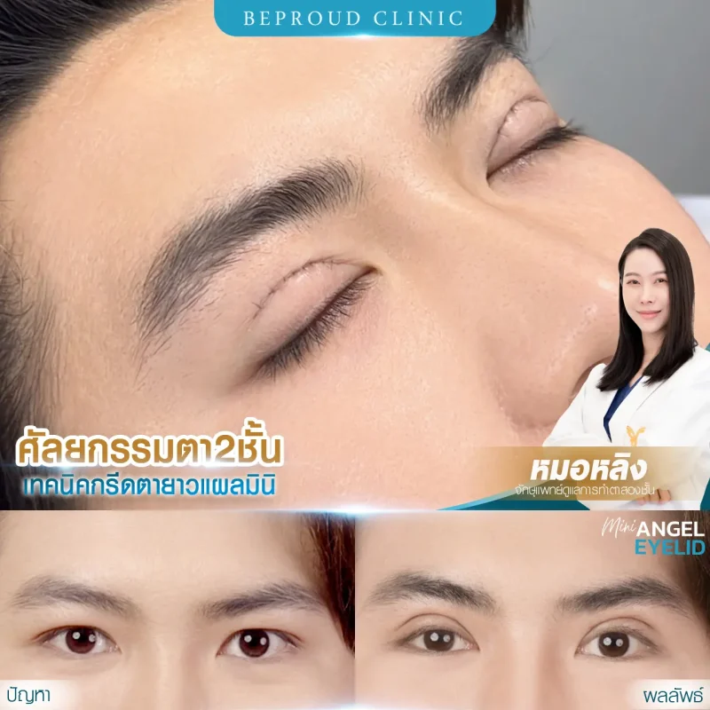 ภาพรีวิวเปรียบเทียบผลลัพธ์ ก่อนทำ-หลังทำศัลยกรรมตาสองชั้นผู้ชาย ของเคสตัวอย่าง เทคนิคกรีดยาวแผลมินิ โดยอ.หมอหลิง บีพราวด์คลินิก