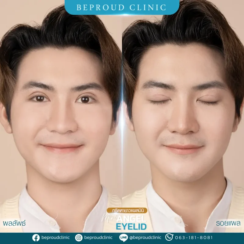 ภาพรีวิวเปรียบเทียบผลลัพธ์ ก่อนทำ-หลังทำศัลยกรรมตาสองชั้นผู้ชาย ของเคสตัวอย่าง เทคนิคกรีดยาวแผลมินิ โดยอ.หมอหลิง บีพราวด์คลินิก