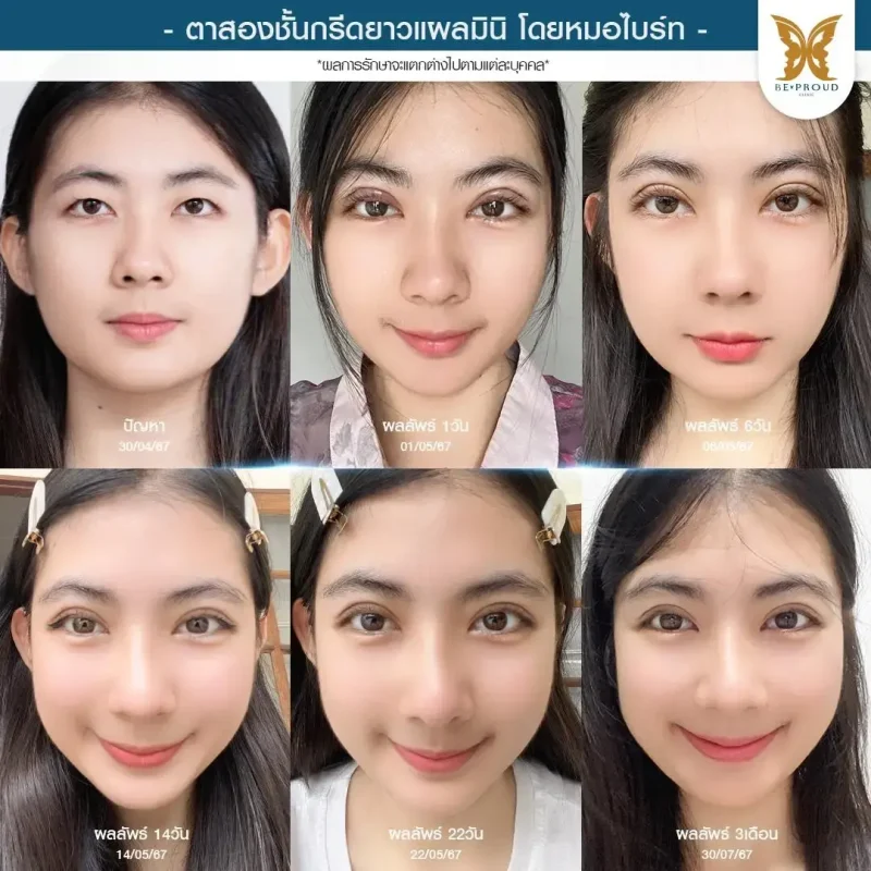 ภาพรีวิวเปรียบเทียบผลลัพธ์ ก่อนทำ-หลังทำศัลยกรรมตาสองชั้น ของเคสตัวอย่าง เทคนิคกรีดตายาวแผลมินิ โดยหมอไบร์ท บีพราวด์คลินิก