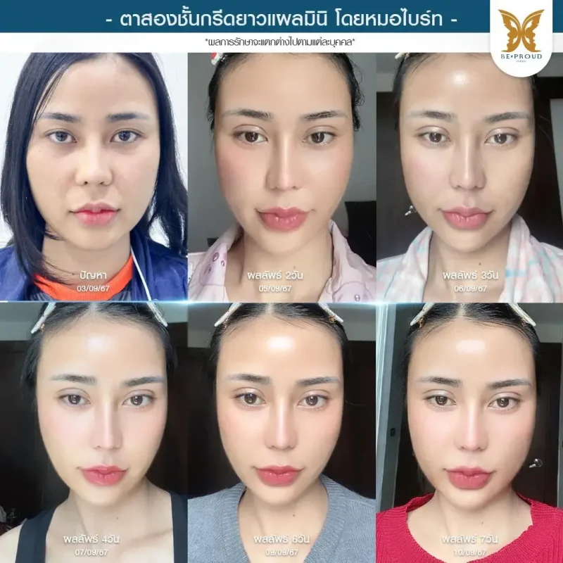 ภาพรีวิวเปรียบเทียบผลลัพธ์ ก่อนทำ-หลังทำศัลยกรรมตาสองชั้น ของเคสตัวอย่าง เทคนิคกรีดตายาวแผลมินิ โดยหมอไบร์ท บีพราวด์คลินิก