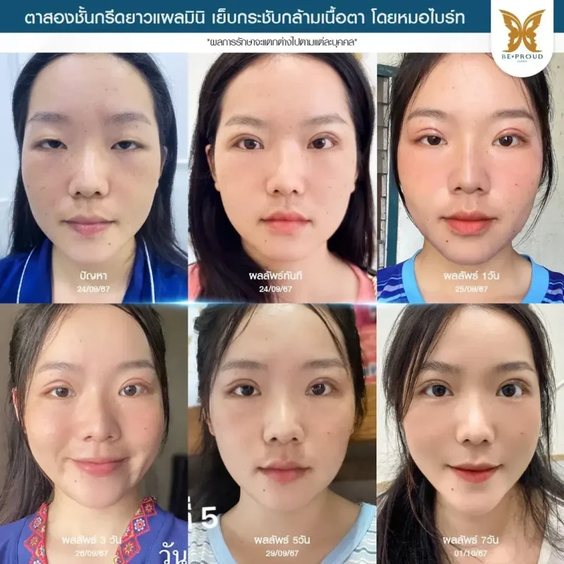 ภาพรีวิวเปรียบเทียบผลลัพธ์ ก่อนทำ-หลังทำศัลยกรรมตาสองชั้น ของเคสตัวอย่าง เทคนิคกรีดตายาวแผลมินิ โดยหมอไบร์ท บีพราวด์คลินิก