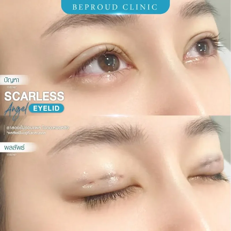 ภาพรีวิวเปรียบเทียบผลลัพธ์ ก่อนทำ-หลังทำศัลยกรรมตาสองชั้น ของเคสตัวอย่าง เทคนิคตาสองชั้นซ่อนแผล โดยอ.หมอหลิง บีพราวด์คลินิก