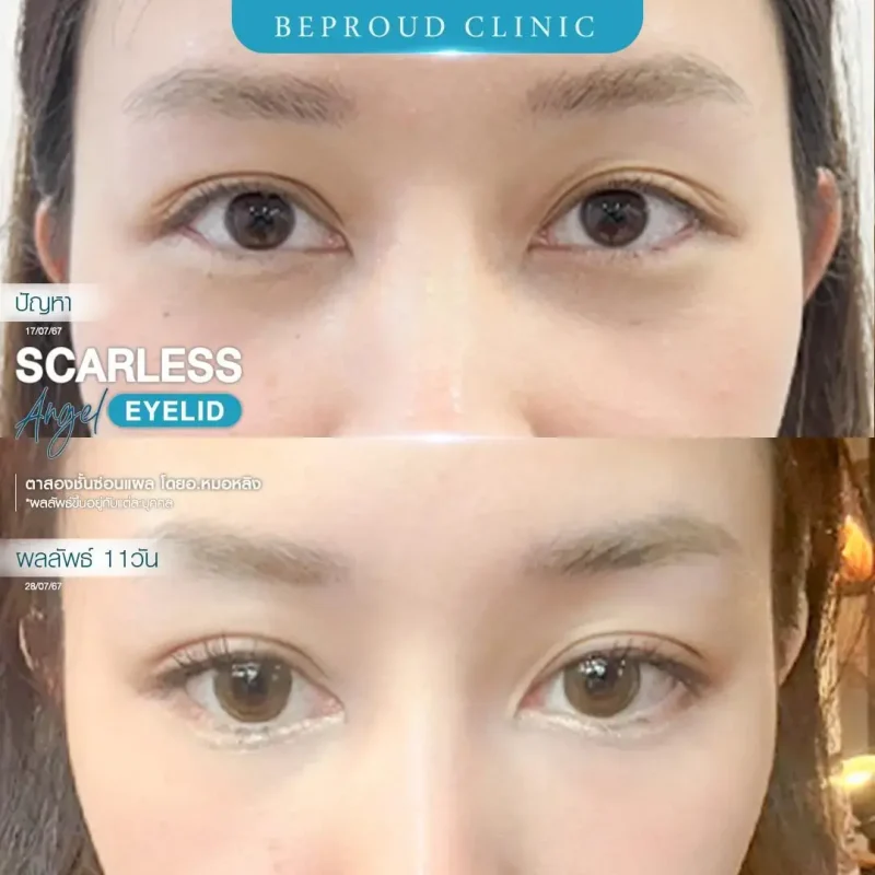 ภาพรีวิวเปรียบเทียบผลลัพธ์ ก่อนทำ-หลังทำศัลยกรรมตาสองชั้น ของเคสตัวอย่าง เทคนิคตาสองชั้นซ่อนแผล โดยอ.หมอหลิง บีพราวด์คลินิก