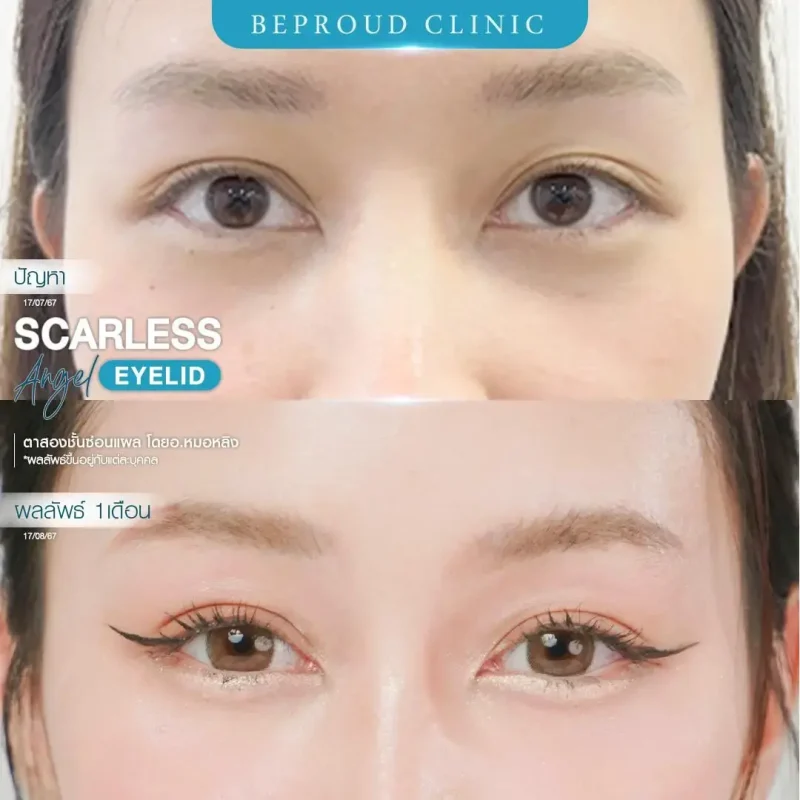 ภาพรีวิวเปรียบเทียบผลลัพธ์ ก่อนทำ-หลังทำศัลยกรรมตาสองชั้น ของเคสตัวอย่าง เทคนิคตาสองชั้นซ่อนแผล โดยอ.หมอหลิง บีพราวด์คลินิก