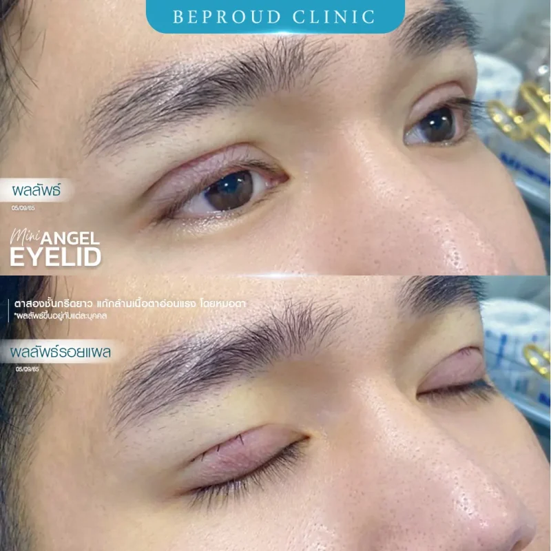 ภาพรีวิวเปรียบเทียบผลลัพธ์ ก่อนทำ-หลังทำศัลยกรรมตาสองชั้นผู้ชาย ของเคสตัวอย่าง เทคนิคกรีดตายาว แก้กล้ามเนื้อตาอ่อนแรง โดยหมอดา บีพราวด์คลินิก