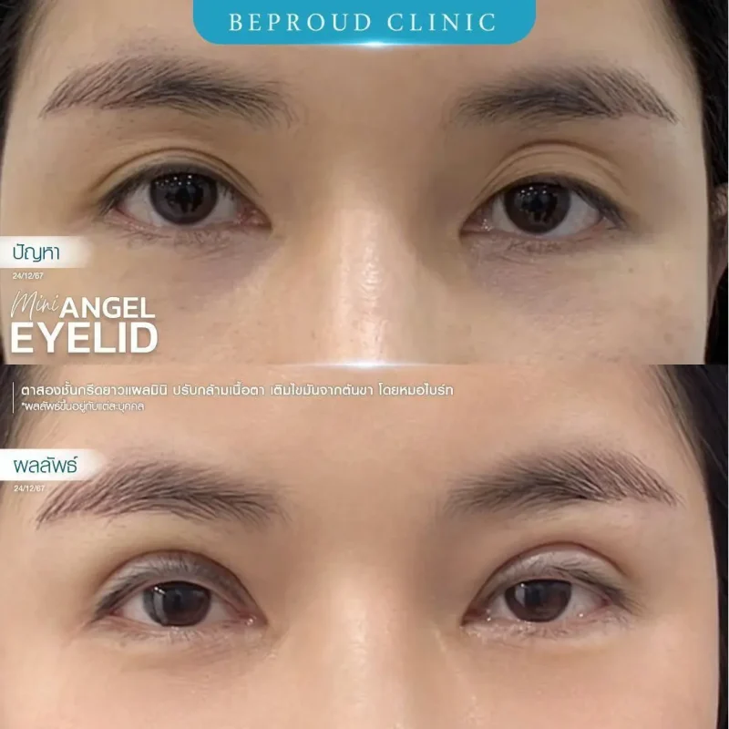 ภาพรีวิวเปรียบเทียบผลลัพธ์ ก่อนทำ-หลังทำศัลยกรรมตาสองชั้น ของเคสตัวอย่าง เทคนิคกรีดตายาวแผลมินิ ปรับกล้ามเนื้อตาอ่อนแรง เติมไขมันจากต้นขา โดยหมอไบร์ท บีพราวด์คลินิก