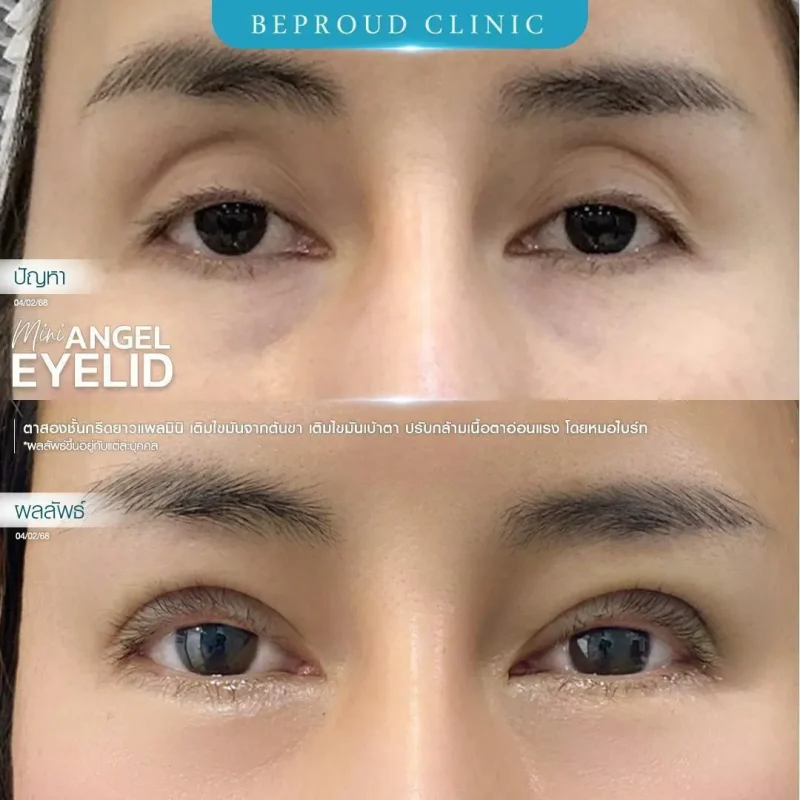 ภาพรีวิวเปรียบเทียบผลลัพธ์ ก่อนทำ-หลังทำศัลยกรรมตาสองชั้น ของเคสตัวอย่าง เทคนิคกรีดตายาวแผลมินิ เติมไขมันจากต้นขา เติมไขมันเบ้าตา ปรับกล้ามเนื้อตาอ่อนแรง โดยหมอไบร์ท บีพราวด์คลินิก