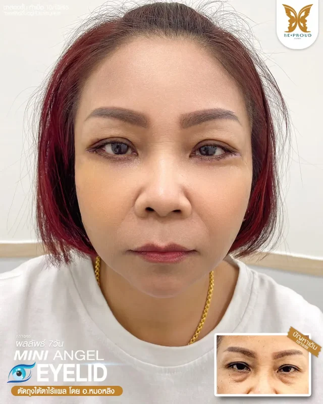 ภาพรีวิวคนสวย ตาสองชั้นกรีดยาว ตัดถุงใต้ตาไร้แผล โดย อ.หมอหลิง (พญ.กัญญ์ชิสา) บีพราวด์คลินิก แสดงผลลัพธ์ ชั้นตาสวยคมชัด ดวงตาดูสดใส