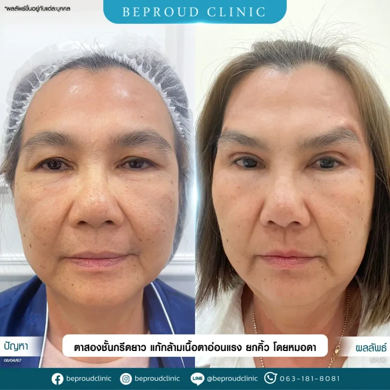 ภาพรีวิวเปรียบเทียบผลลัพธ์ ก่อนทำ-หลังทำศัลยกรรมตาสองชั้น ของเคสตัวอย่าง เทคนิคกรีดตายาว แก้กล้ามเนื้อตาอ่อนแรง ยกคิ้ว โดยหมอดา บีพราวด์คลินิก