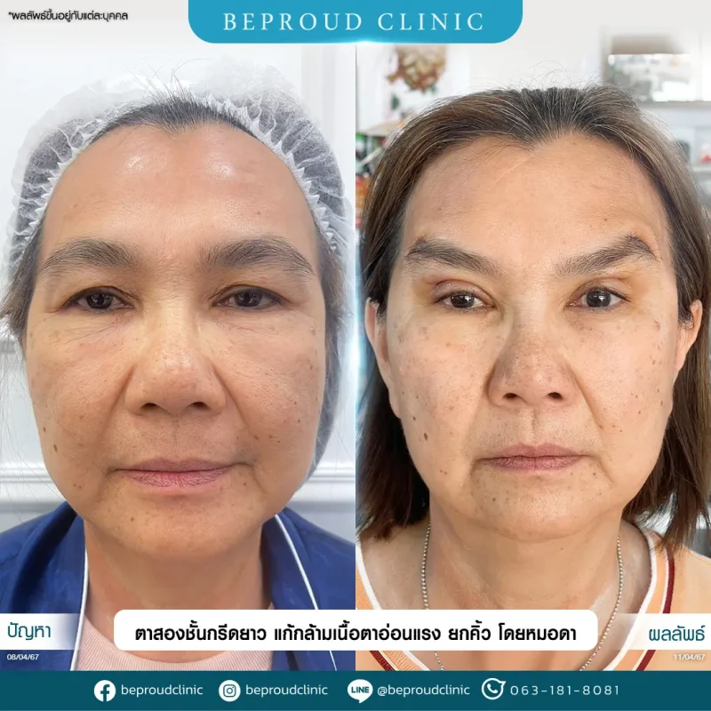 ภาพรีวิวเปรียบเทียบผลลัพธ์ ก่อนทำ-หลังทำศัลยกรรมตาสองชั้น ของเคสตัวอย่าง เทคนิคกรีดตายาว แก้กล้ามเนื้อตาอ่อนแรง ยกคิ้ว โดยหมอดา บีพราวด์คลินิก