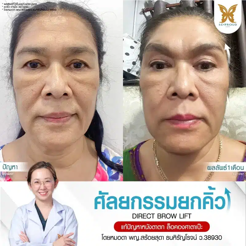 ภาพรีวิวเปรียบเทียบผลลัพธ์ ก่อนทำ-หลังทำศัลยกรรมยกคิ้ว โดยหมอดา บีพราวด์คลินิก