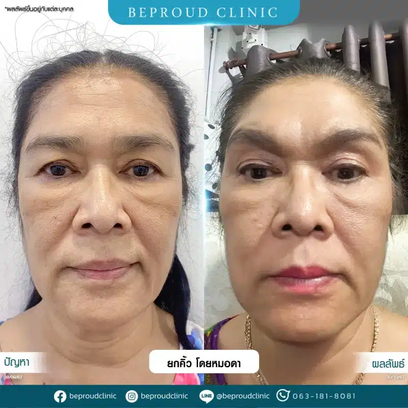 ภาพรีวิวเปรียบเทียบผลลัพธ์ ก่อนทำ-หลังทำศัลยกรรมยกคิ้ว โดยหมอดา บีพราวด์คลินิก