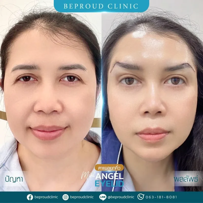 ภาพรีวิวเปรียบเทียบผลลัพธ์ ก่อนทำ-หลังทำศัลยกรรมยกคิ้ว โดยอ.หมอหลิง บีพราวด์คลินิก