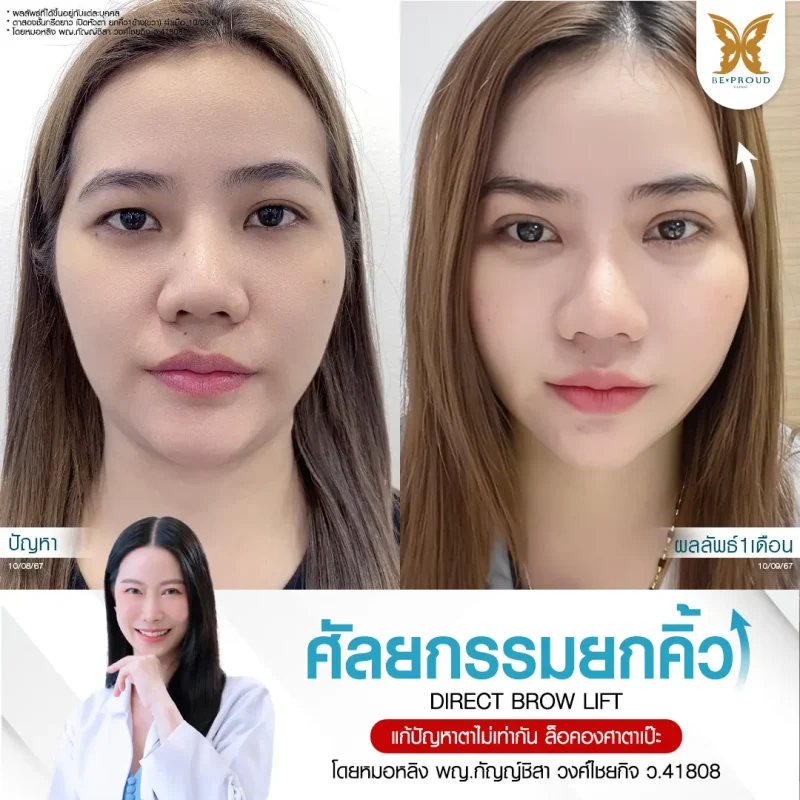 ภาพรีวิวเปรียบเทียบผลลัพธ์ ก่อนทำ-หลังทำศัลยกรรมตาสองชั้น ของเคสตัวอย่าง เทคนิคกรีดตายาว เปิดหัวตา ยกคิ้ว โดยอ.หมอหลิง บีพราวด์คลินิก