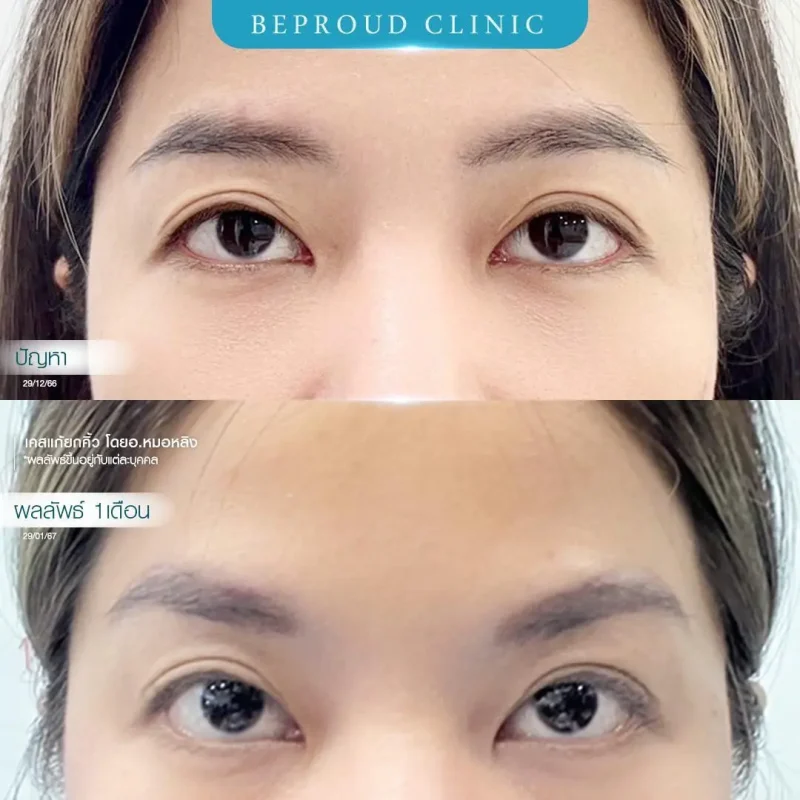 ภาพรีวิวเปรียบเทียบผลลัพธ์ ก่อนทำ-หลังทำศัลยกรรมแก้ยกคิ้ว โดยอ.หมอหลิง บีพราวด์คลินิก