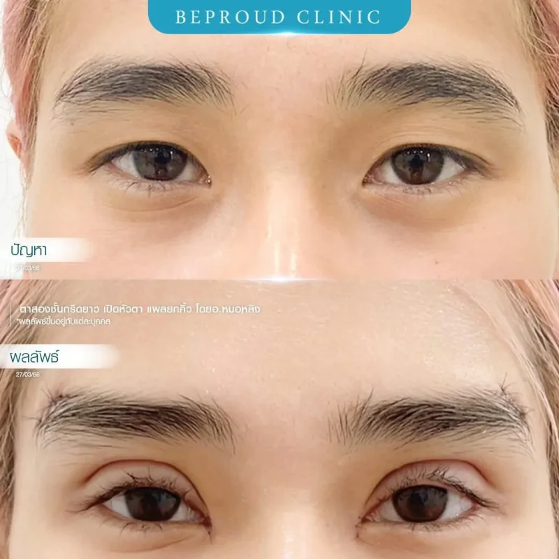 ภาพรีวิวเปรียบเทียบผลลัพธ์ ก่อนทำ-หลังทำศัลยกรรมตาสองชั้น ของเคสตัวอย่าง เทคนิคกรีดตายาว เปิดหัวตา แผลใต้คิ้ว โดยอ.หมอหลิง บีพราวด์คลินิก
