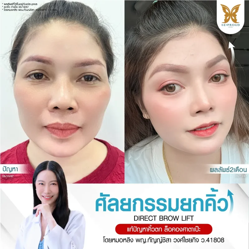 ภาพรีวิวเปรียบเทียบผลลัพธ์ ก่อนทำ-หลังทำศัลยกรรมยกคิ้ว โดยอ.หมอหลิง บีพราวด์คลินิก