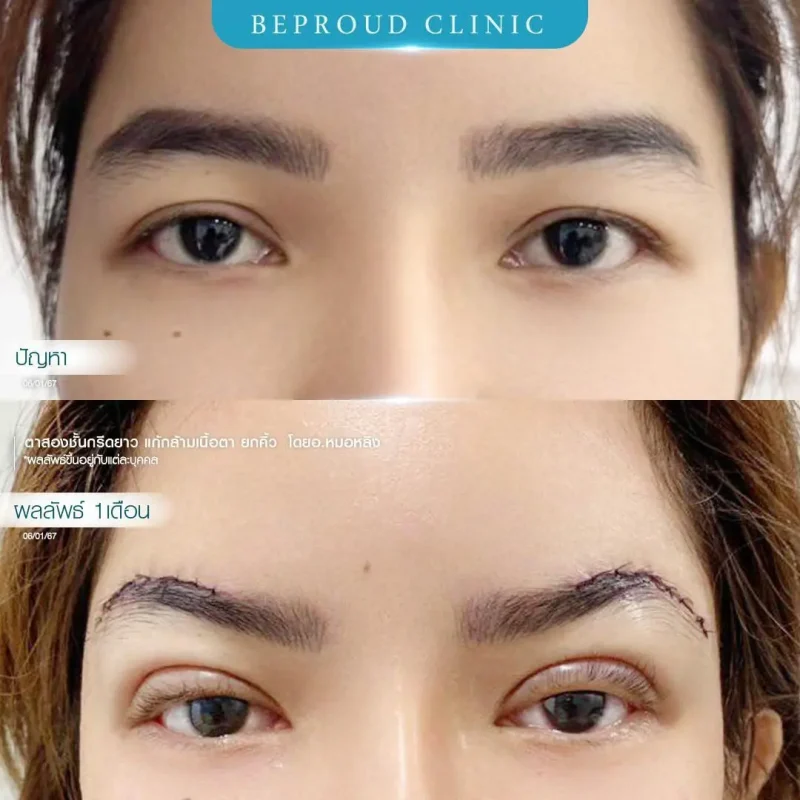 ภาพรีวิวเปรียบเทียบผลลัพธ์ ก่อนทำ-หลังทำศัลยกรรมตาสองชั้น ของเคสตัวอย่าง เทคนิคกรีดตายาว แก้กล้ามเนื้อตา ยกคิ้ว โดยอ.หมอหลิง บีพราวด์คลินิก