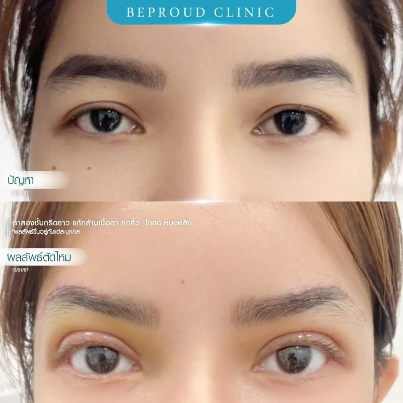 ภาพรีวิวเปรียบเทียบผลลัพธ์ ก่อนทำ-หลังทำศัลยกรรมตาสองชั้น ของเคสตัวอย่าง เทคนิคกรีดตายาว แก้กล้ามเนื้อตา ยกคิ้ว โดยอ.หมอหลิง บีพราวด์คลินิก