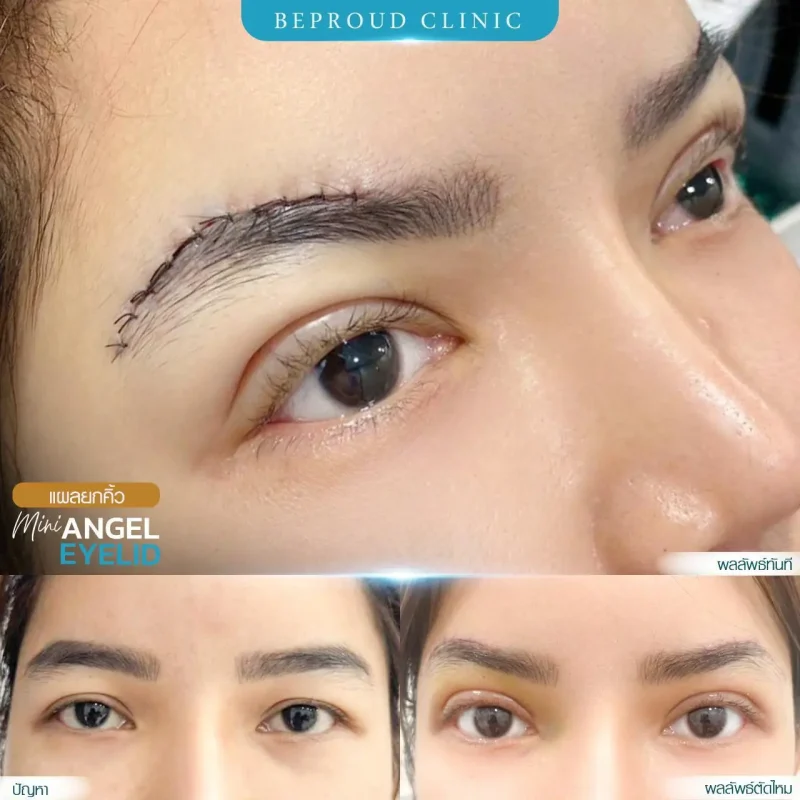 ภาพรีวิวเปรียบเทียบผลลัพธ์ ก่อนทำ-หลังทำศัลยกรรมยกคิ้ว โดยอ.หมอหลิง บีพราวด์คลินิก