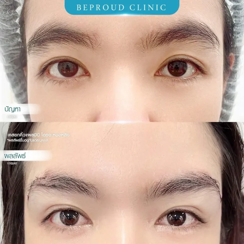 ภาพรีวิวเปรียบเทียบผลลัพธ์ ก่อนทำ-หลังทำศัลยกรรมยกคิ้วแผลมินิ โดยอ.หมอหลิง บีพราวด์คลินิก