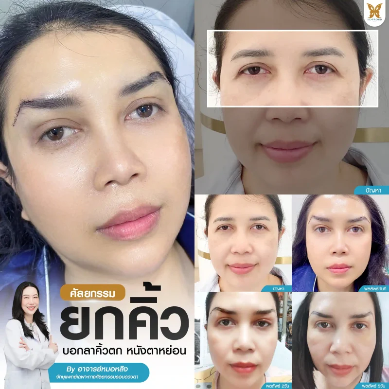 ภาพรีวิวเปรียบเทียบผลลัพธ์ ก่อนทำ-หลังทำศัลยกรรมยกคิ้ว โดยอ.หมอหลิง บีพราวด์คลินิก