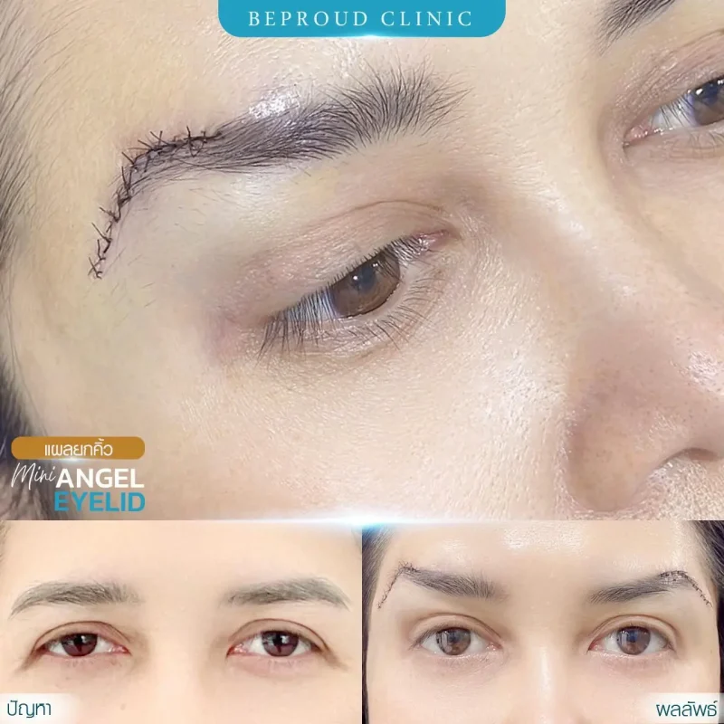 ภาพรีวิวเปรียบเทียบผลลัพธ์ ก่อนทำ-หลังทำศัลยกรรมยกคิ้ว โดยอ.หมอหลิง บีพราวด์คลินิก