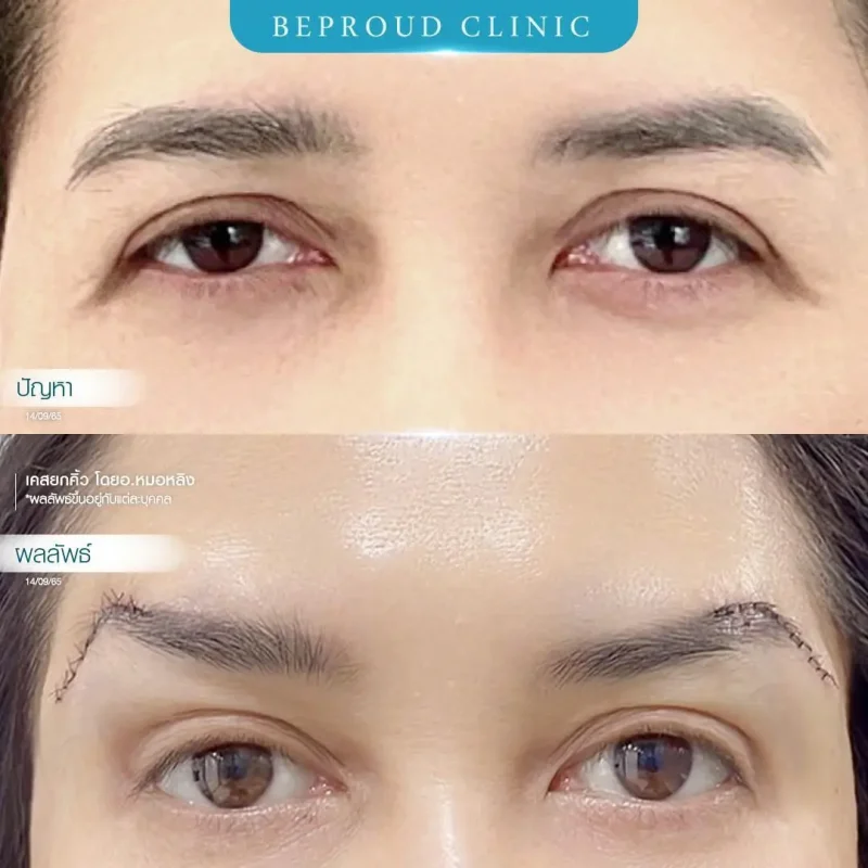 ภาพรีวิวเปรียบเทียบผลลัพธ์ ก่อนทำ-หลังทำศัลยกรรมยกคิ้ว โดยอ.หมอหลิง บีพราวด์คลินิก