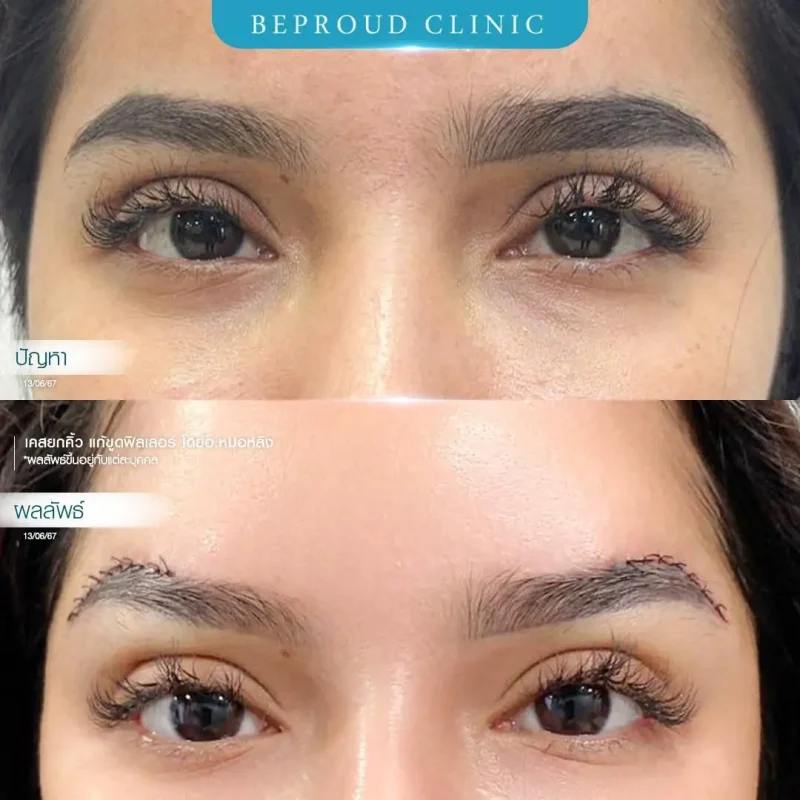 ภาพรีวิวเปรียบเทียบผลลัพธ์ ก่อนทำ-หลังทำศัลยกรรมยกคิ้ว แก้ขูดฟิลเลอร์ โดยอ.หมอหลิง บีพราวด์คลินิก