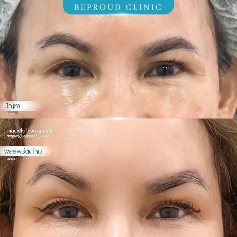 ภาพรีวิวเปรียบเทียบผลลัพธ์ ก่อนทำ-หลังทำศัลยกรรมยกคิ้ว โดยอ.หมอหลิง บีพราวด์คลินิก