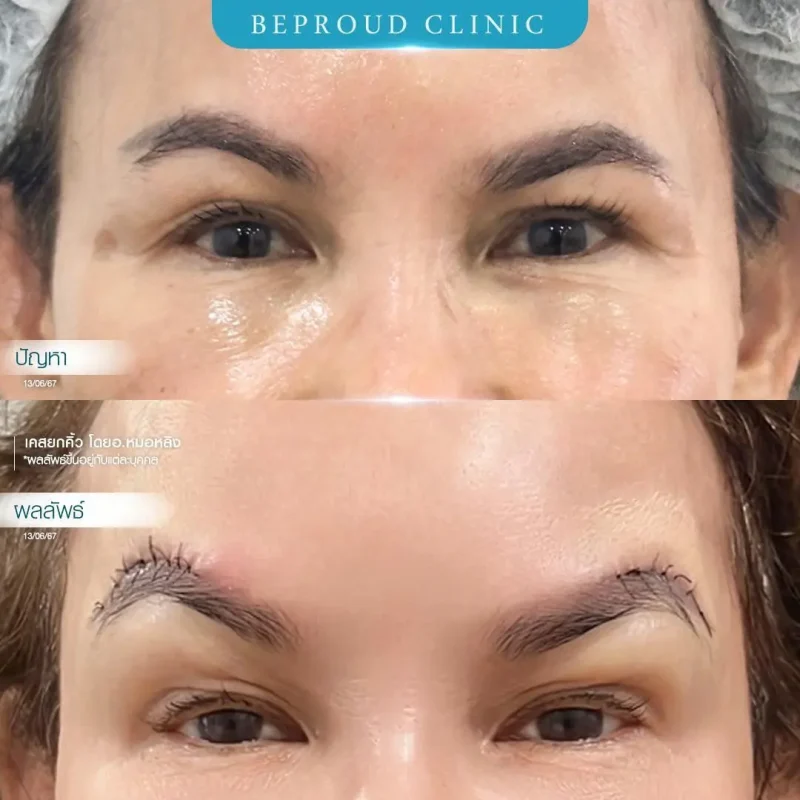 ภาพรีวิวเปรียบเทียบผลลัพธ์ ก่อนทำ-หลังทำศัลยกรรมยกคิ้ว โดยอ.หมอหลิง บีพราวด์คลินิก