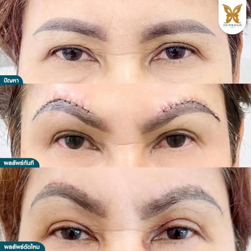 ภาพรีวิวเปรียบเทียบผลลัพธ์ ก่อนทำ-หลังทำศัลยกรรมตาสองชั้น ของเคสตัวอย่าง เทคนิคกรีดตายาว แก้กล้ามเนื้อตาอ่อนแรง ยกคิ้ว โดยอ.หมอหลิง บีพราวด์คลินิก