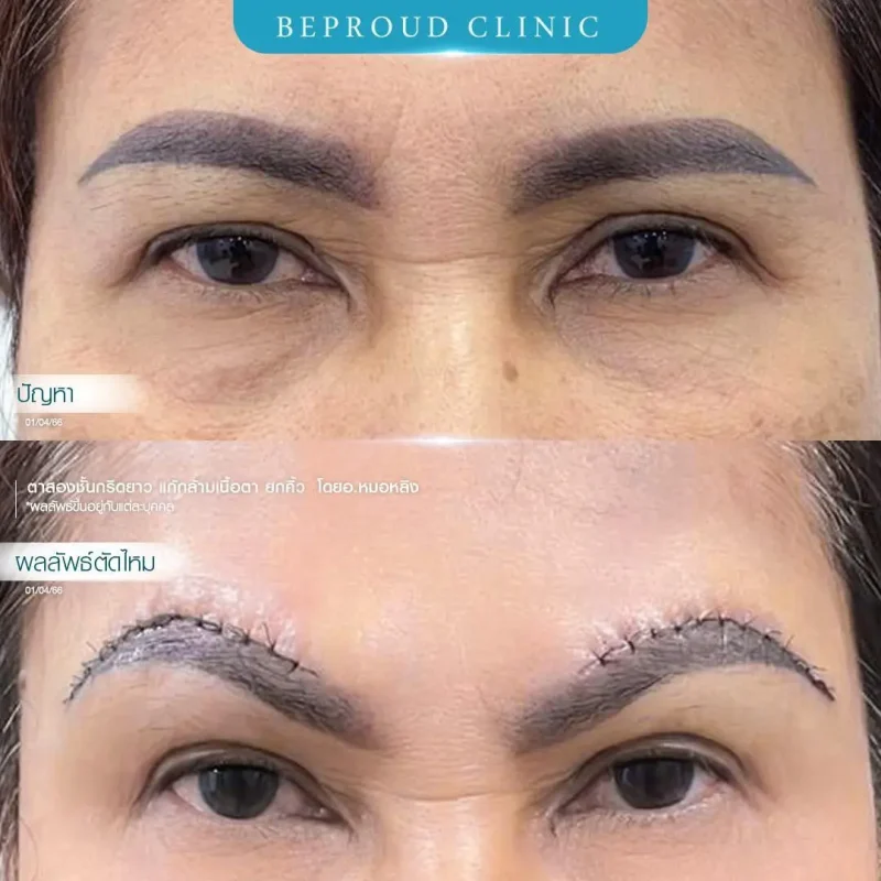 ภาพรีวิวเปรียบเทียบผลลัพธ์ ก่อนทำ-หลังทำศัลยกรรมตาสองชั้น ของเคสตัวอย่าง เทคนิคกรีดตายาว แก้กล้ามเนื้อตาอ่อนแรง ยกคิ้ว โดยอ.หมอหลิง บีพราวด์คลินิก