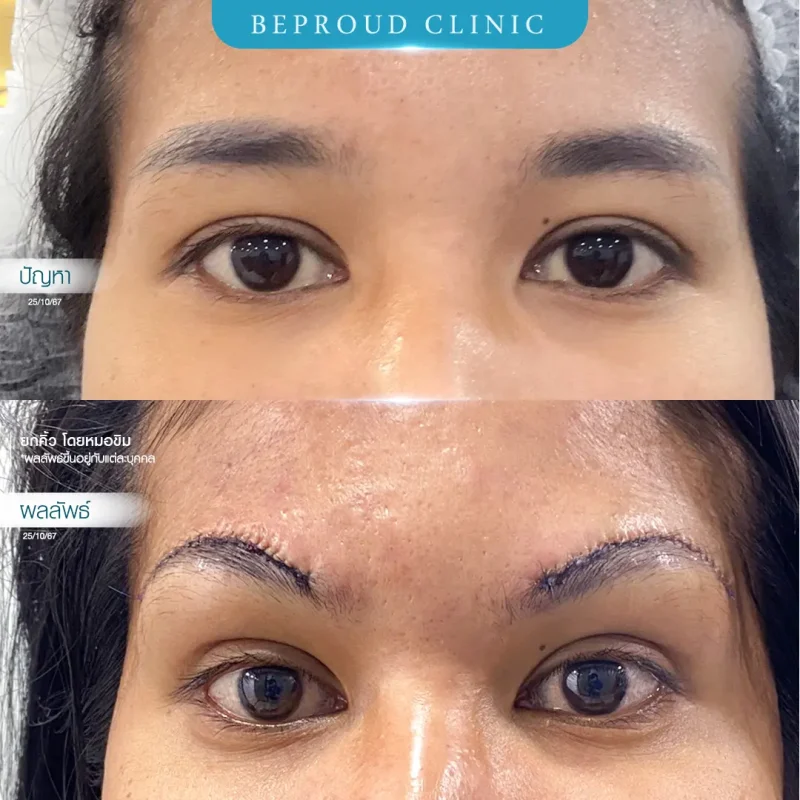 ภาพรีวิวเปรียบเทียบผลลัพธ์ ก่อนทำ-หลังทำศัลยกรรมยกคิ้ว โดยหมอขิม บีพราวด์คลินิก