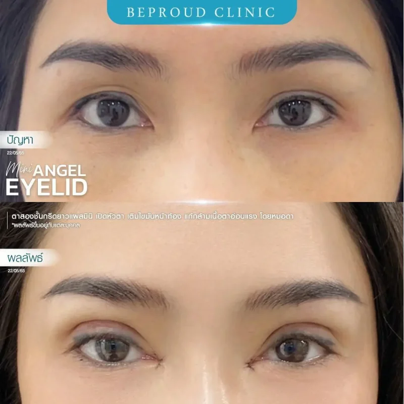 ภาพรีวิวเปรียบเทียบผลลัพธ์ ก่อนทำ-หลังทำศัลยกรรมตาสองชั้น ของเคสตัวอย่าง เทคนิคกรีดตายาวแผลมินิ เปิดหัวตา เติมไขมันหน้าท้อง แก้กล้ามเนื้อตาอ่อนแรง โดยหมอดา บีพราวด์คลินิก