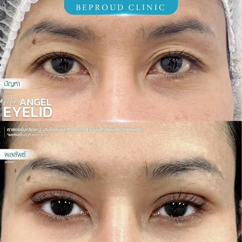 ภาพรีวิวเปรียบเทียบผลลัพธ์ ก่อนทำ-หลังทำศัลยกรรมตาสองชั้น ของเคสตัวอย่าง เทคนิคกรีดตายาว เติมไขมันหน้าท้อง แก้กล้ามเนื้อตาอ่อนแรง โดยหมอดา บีพราวด์คลินิก